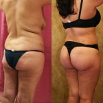 Buttock Lift/Augmentation Before & After Patient #6152