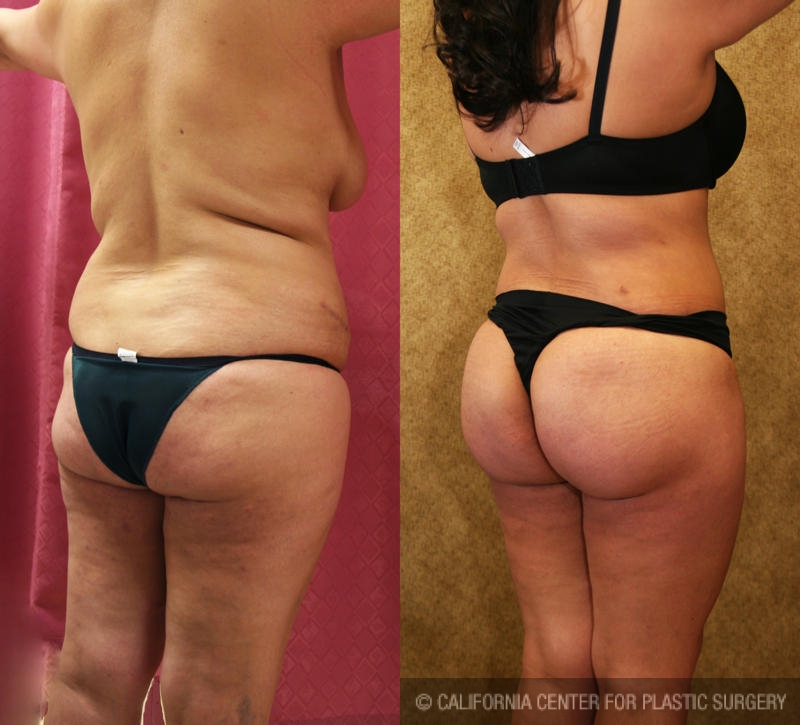 Buttock Lift/Augmentation Before & After Patient #6152