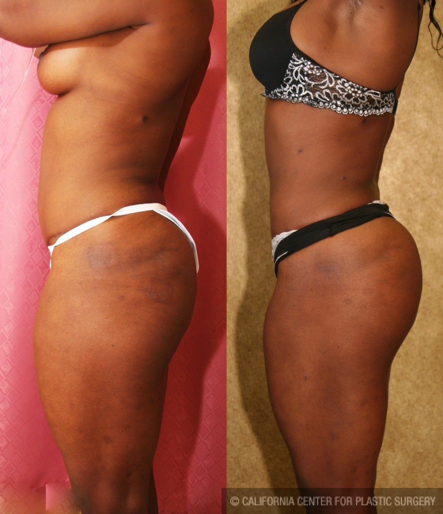 Buttock Lift/Augmentation Before & After Patient #6142