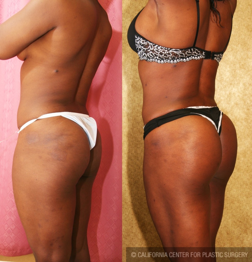 Buttock Lift/Augmentation Before & After Patient #6142