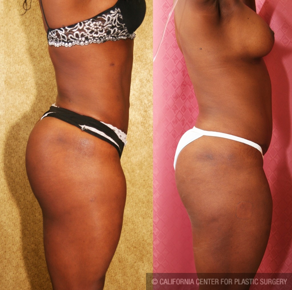 Buttock Lift/Augmentation Before & After Patient #6142