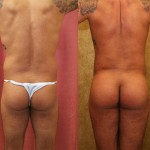 Buttock Lift/Augmentation Before & After Patient #6089