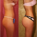 Buttock Lift/Augmentation Before & After Patient #6065