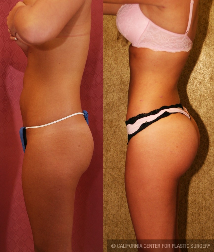 Buttock Lift/Augmentation Before & After Patient #6065