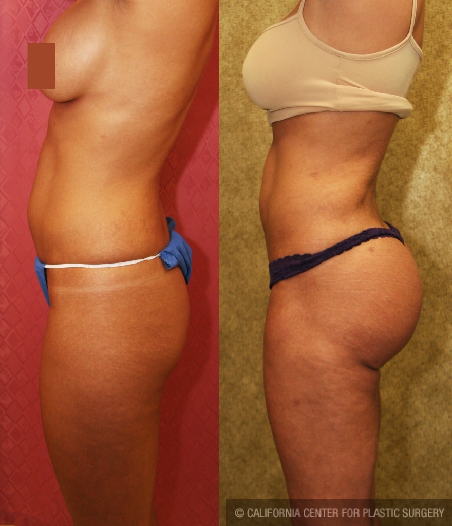 Buttock Lift/Augmentation Before & After Patient #6079