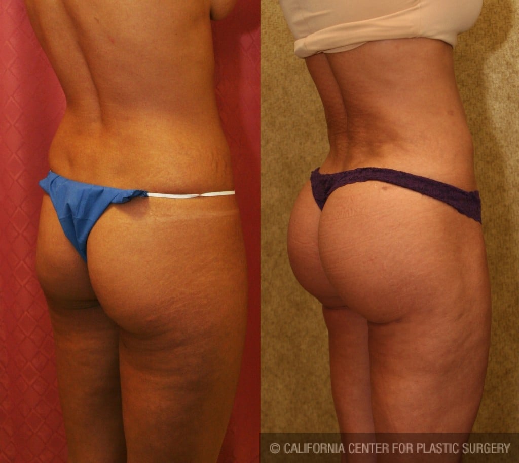 Buttock Lift/Augmentation Before & After Patient #6079