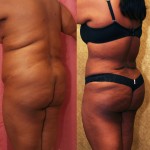 Buttock Lift/Augmentation Before & After Patient #6124