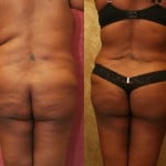 Buttock Lift/Augmentation Before & After Patient #6124