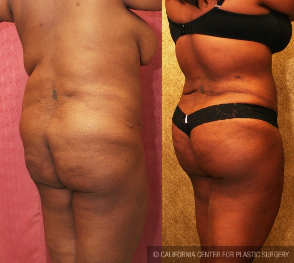 Buttock Lift/Augmentation Before & After Patient #6124
