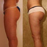 Buttock Lift/Augmentation Before & After Patient #6096