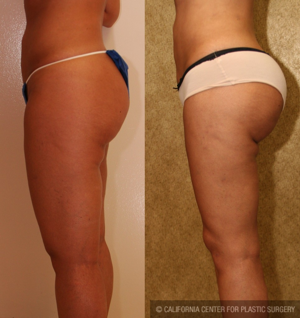 Buttock Lift/Augmentation Before & After Patient #6096