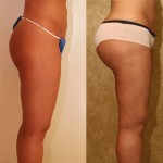 Buttock Lift/Augmentation Before & After Patient #6096