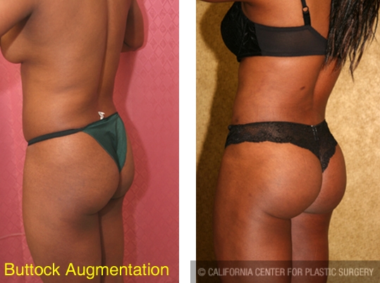 Buttock Lift/Augmentation Before & After Patient #6102