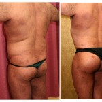 Buttock Lift/Augmentation Before & After Patient #6116