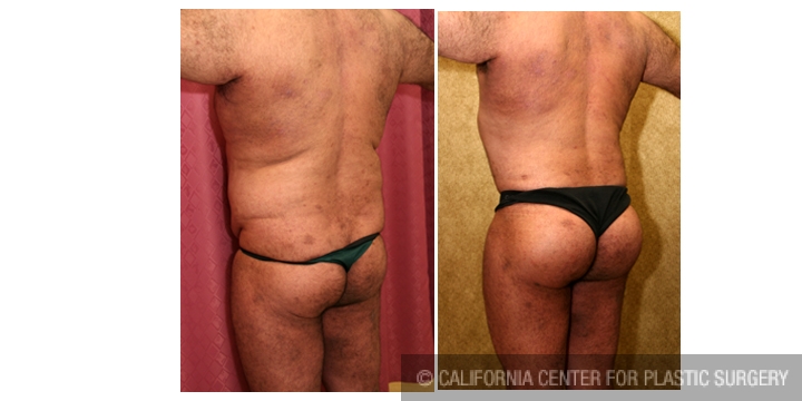 Buttock Lift/Augmentation Before & After Patient #6116