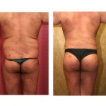 Buttock Lift/Augmentation Before & After Patient #6116