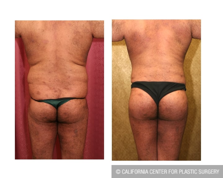 Buttock Lift/Augmentation Before & After Patient #6116