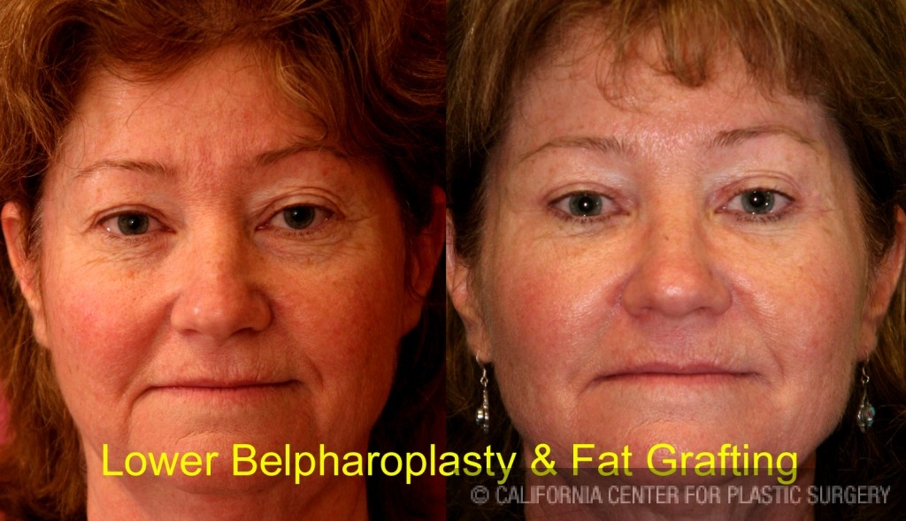 Facial Fat Grafting Before & After Patient #6746