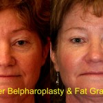 Facial Fat Grafting Before & After Patient #6746