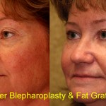 Facial Fat Grafting Before & After Patient #6746