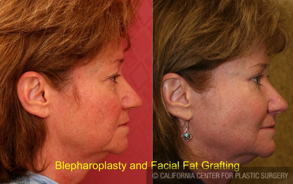 Facial Fat Grafting Before & After Patient #6746