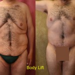 Male Tummy Tuck (abdominoplasty) Before & After Patient #6023