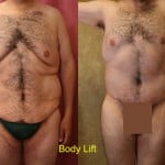 Body Lift Before & After Patient #6041