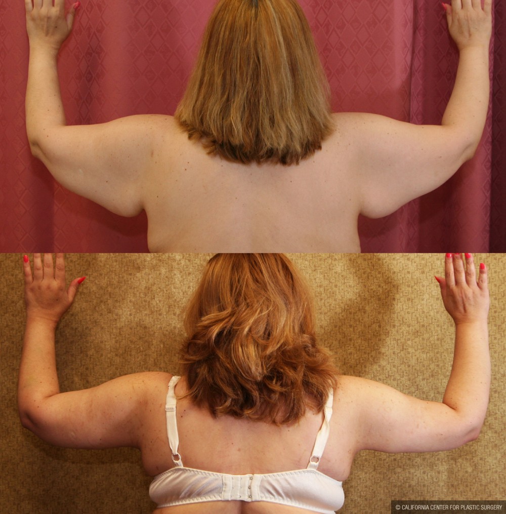 Arm Lift (Brachioplasty) Before & After Patient #6173