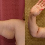 Arm Lift (Brachioplasty) Before & After Patient #6173