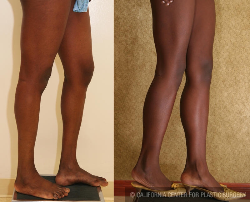 Calf Augmentation Before & After Patient #6869