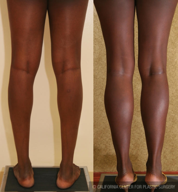 Calf Augmentation Before & After Patient #6869