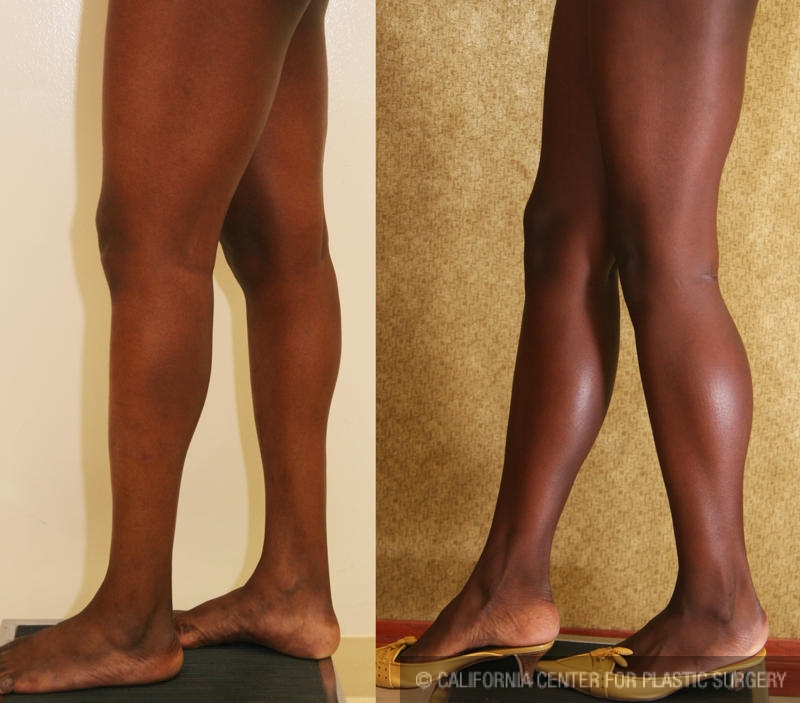 Calf Augmentation Before & After Patient #6869