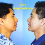 Chin Augmentation Before & After Patient #6799