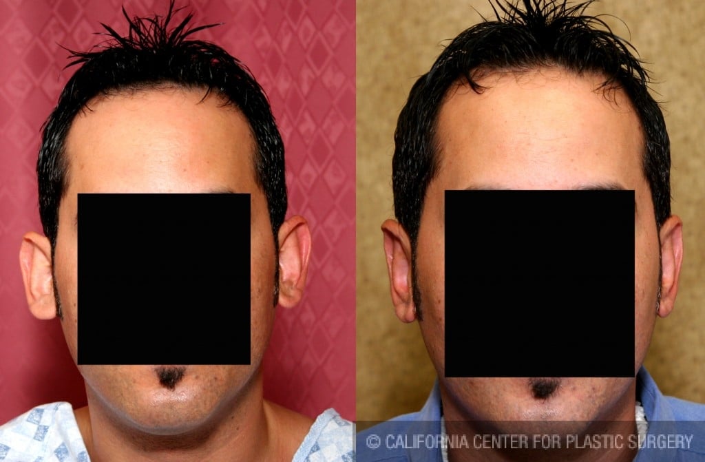 Ear (Otoplasty) Before & After Patient #6451