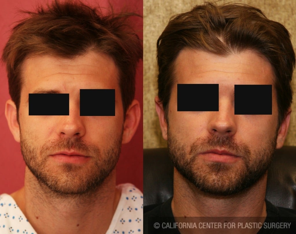 Ear (Otoplasty) Before & After Patient #6447