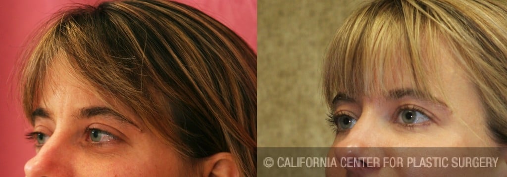 Eyelid (Blepharoplasty) Before & After Patient #6578