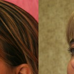 Eyelid (Blepharoplasty) Before & After Patient #6578