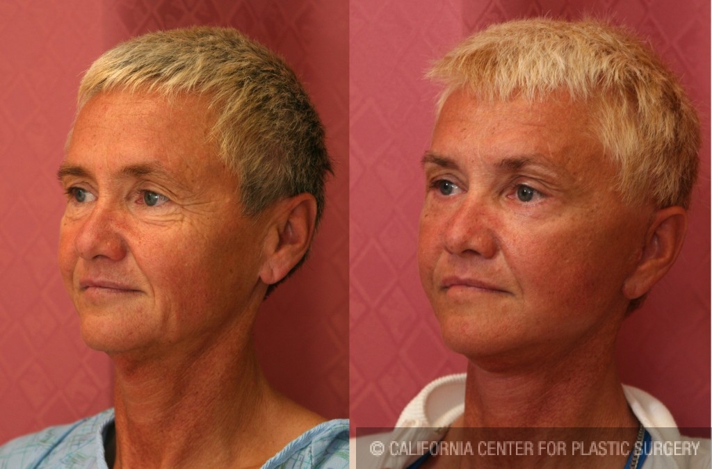 Eyelid (Blepharoplasty) Before & After Patient #6559
