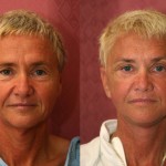 Facelift Before & After Patient #6778