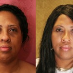 Eyelid (Blepharoplasty) Before & After Patient #6592