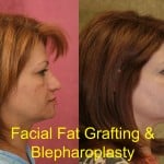 Facial Fat Grafting Before & After Patient #6757