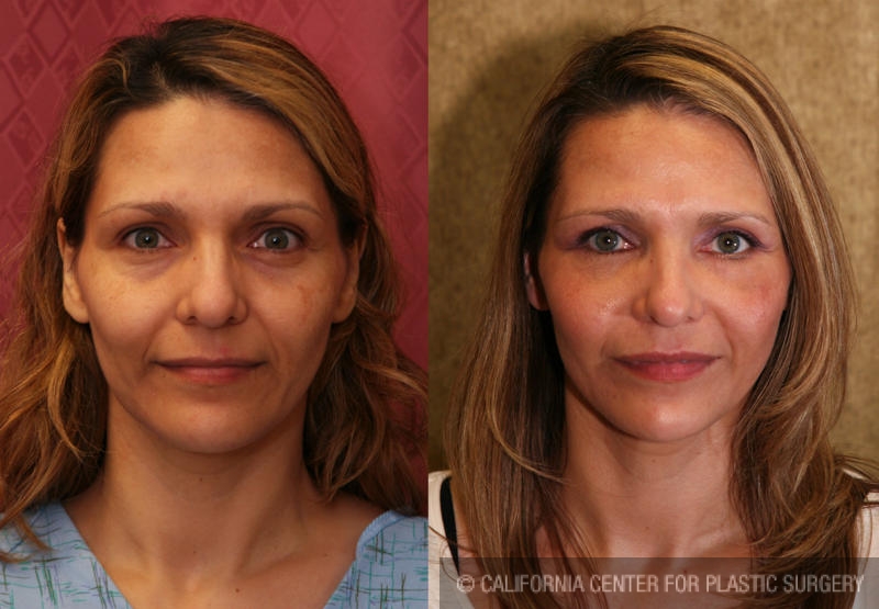 Eyelid (Blepharoplasty) Before & After Patient #6486