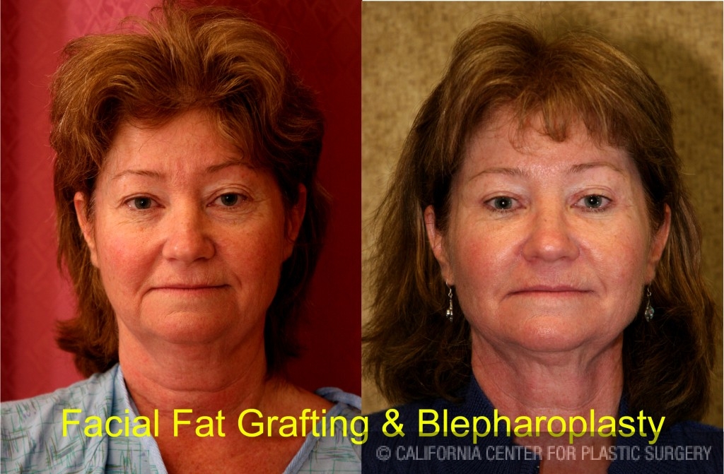 Facial Fat Grafting Before & After Patient #6746