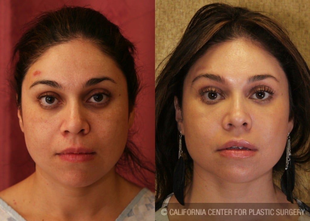 Eyelid (Blepharoplasty) Before & After Patient #6570