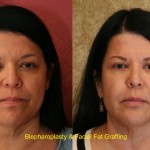 Eyelid (Blepharoplasty) Before & After Patient #6583