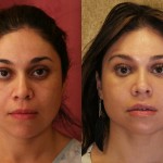 Facial Fat Grafting Before & After Patient #6734