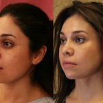 Eyelid (Blepharoplasty) Before & After Patient #6570