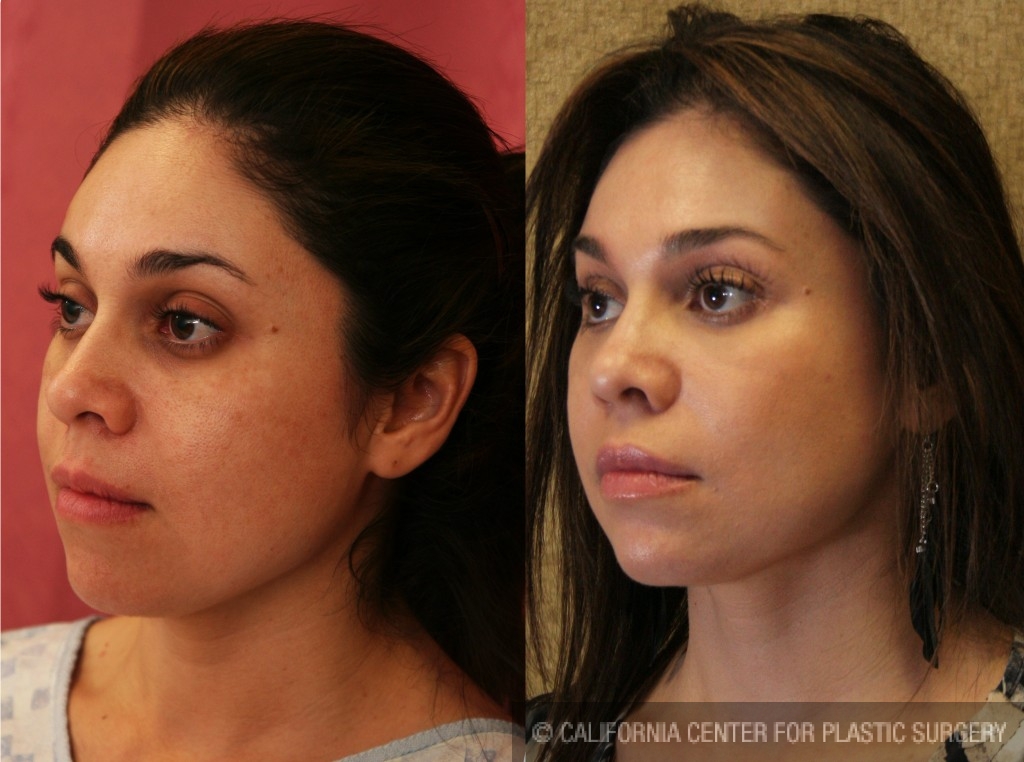 Facial Fat Grafting Before & After Patient #6734