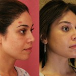 Eyelid (Blepharoplasty) Before & After Patient #6570