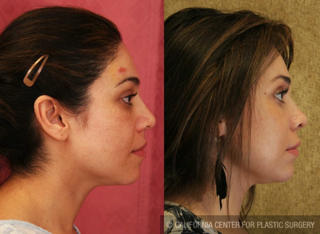 Facial Fat Grafting Before & After Patient #6734